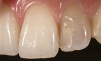 前歯1歯（単冠）のオールセラミックス　術前