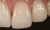 前歯1歯（単冠）のオールセラミックス　術後